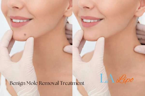 Before-and-after results following benign mole-removal treatment Thatcham