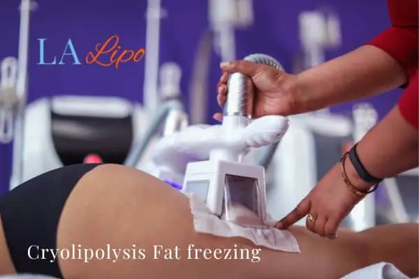 women getting fat freezing Thatcham