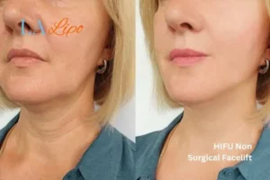 hi-fu for wrinkles Thatcham before and after results