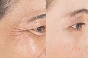 Before and after results of woman - HI-fu wrinkles reduction treatment Thatcham