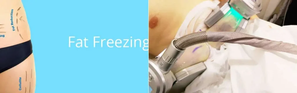 Fat freezing Thatcham on multiple areas of the body