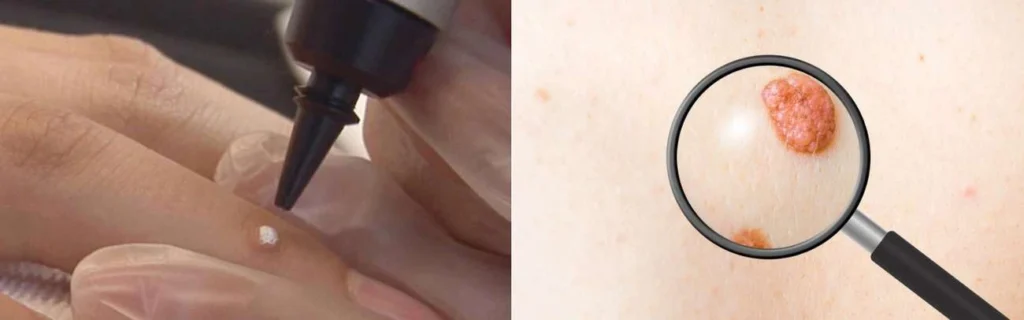 CryoPen practitioner Thatcham assessing a benign mole before treatment