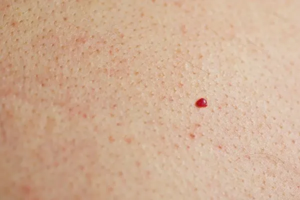 close up of a cherry angioma Thatcham