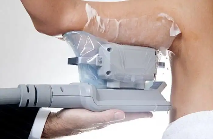 Picture of fat freezing Thatcham on the upper arms.