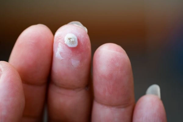 wart on person finger - cryotherapy to treat from LA LIPO Thatcham