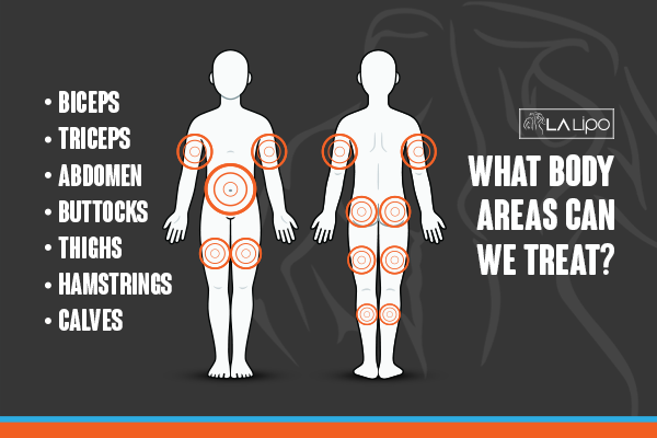 Diagram to show areas you can have LA-EMS Body Sculpting Treatment Thatcham