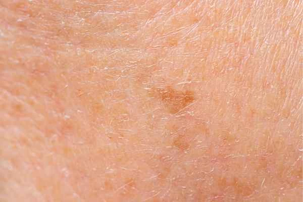 close up picture of age spots Thatcham