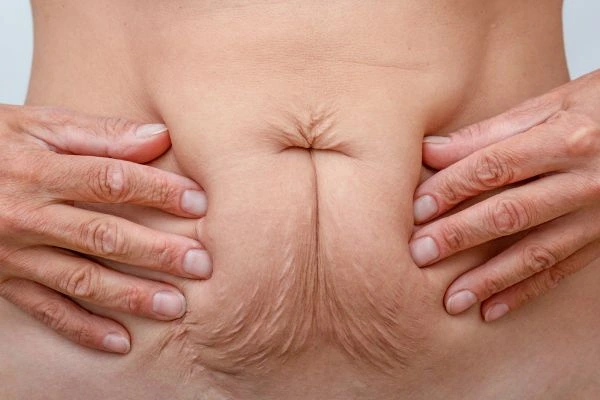 Image of a woman's stomach with loose skin - example of skin tightening Thatcham options