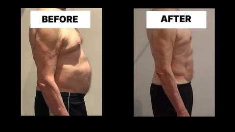 What Symptoms Can Diastasis Recti Cause in Men? Weak Core, Back Pain and Poor Posture Thatcham